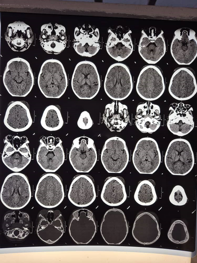 Acute soft head syndrome and orbital compression syndrome in a child with sickle cell disease: a case report.