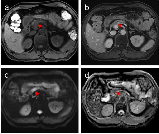 Preoperative MRI and CA19-9 for predicting occult lymph node metastasis in small pancreatic ductal adenocarcinoma (≤ 2 cm).