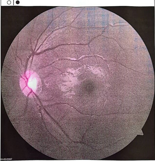 Acute soft head syndrome and orbital compression syndrome in a child with sickle cell disease: a case report.