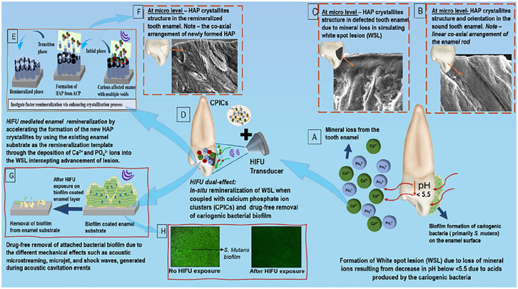Potential of High-Intensity Focused Ultrasound in Enamel Remineralization.