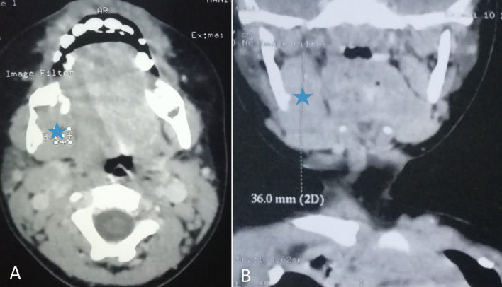 Management of mandibular infantile desmoid fibromatosis: A pediatric case report.