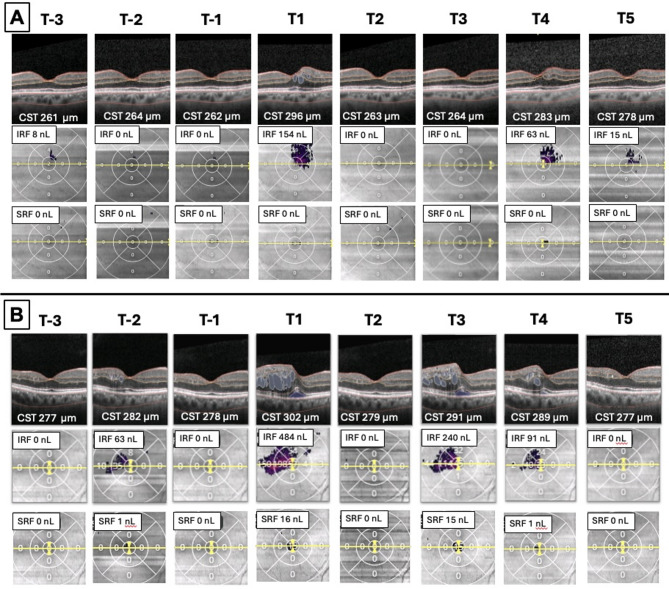 Short and long-term impact of intravitreal anti-VEGF therapy interruption in retinal vein occlusion during the COVID-19 pandemic: functional outcomes and AI-based fluid analysis of macular edema.
