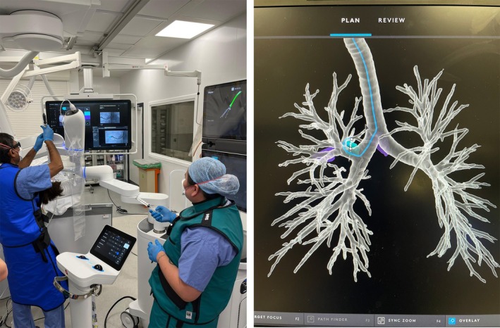 Contemporary Concise Review 2024: New Techniques in Interventional Pulmonology.