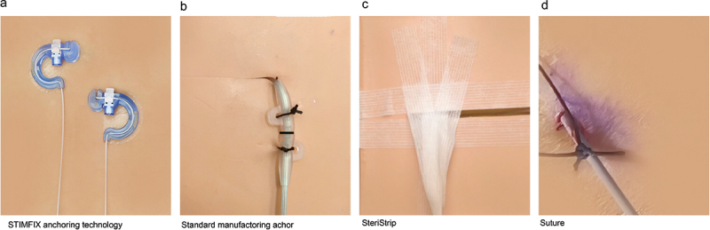 STIMFIX™ anchoring in percutaneous spinal cord stimulation trials: interim analysis of a multicenter study.