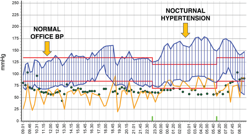 Nocturnal blood pressure: pathophysiology, measurement and clinical implications. Position paper of the European Society of Hypertension.