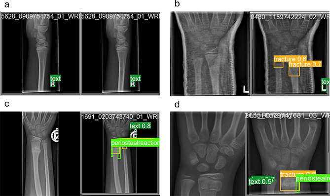 Enhancing pediatric distal radius fracture detection: optimizing YOLOv8 with advanced AI and machine learning techniques.