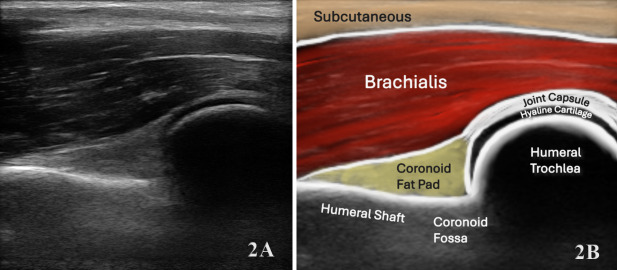 Diagnostic Musculoskeletal Ultrasound in the Evaluation of the Brachialis.