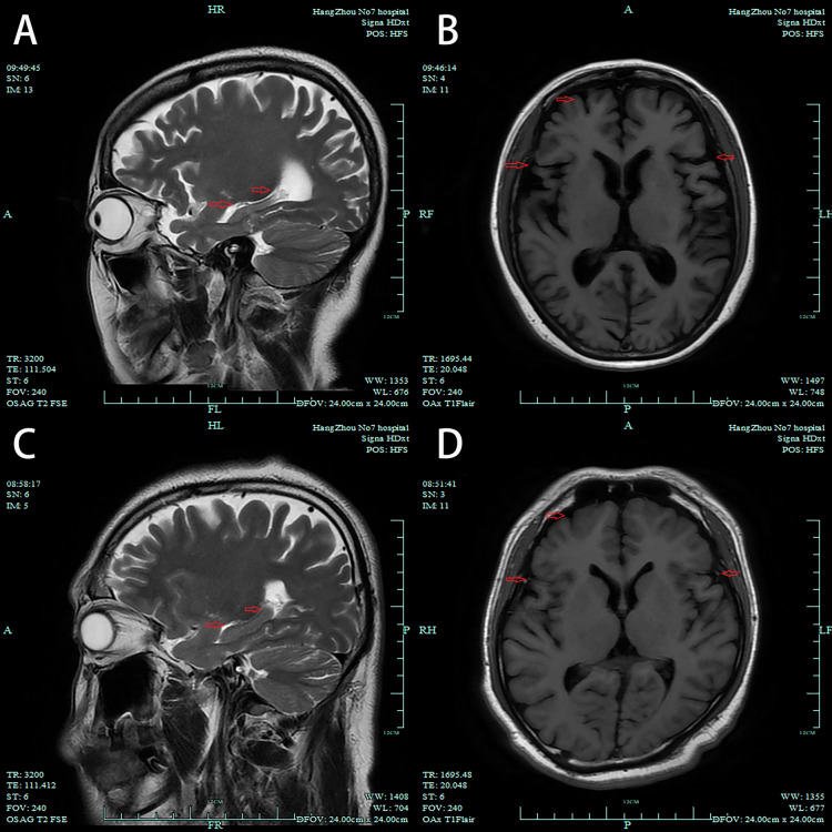 Case Report: Acute Psychiatric Behavioral Disturbance in a Patient with Presenilin 1 Gene Mutation Associated with Familial Alzheimer's Disease.