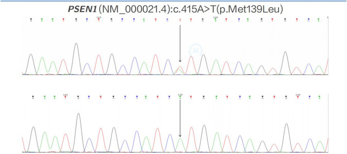 Case Report: Acute Psychiatric Behavioral Disturbance in a Patient with Presenilin 1 Gene Mutation Associated with Familial Alzheimer's Disease.