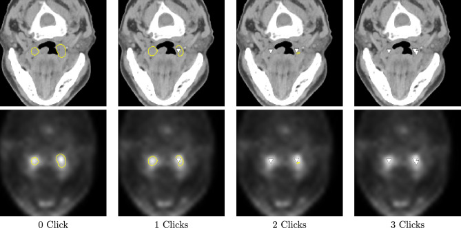 Interactive 3D segmentation for primary gross tumor volume in oropharyngeal cancer.