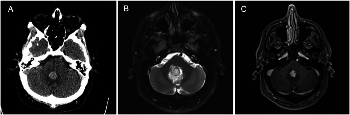 Yield of MRI in patients with spontaneous deep intracerebral hemorrhage.