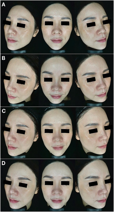 Fractional and Non-Fractional Picosecond Nd:YAG Lasers Combined With Fractional Picosecond KTP Laser for the Treatment of Melasma in Female Chinese.
