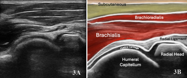 Diagnostic Musculoskeletal Ultrasound in the Evaluation of the Brachialis.