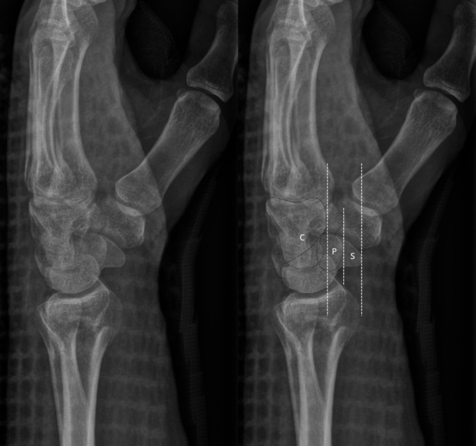 Distal radius fracture - Supination underestimates dorsal tilt in distal radius fracture radiographs: a case report.