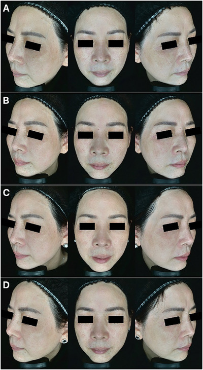 Fractional and Non-Fractional Picosecond Nd:YAG Lasers Combined With Fractional Picosecond KTP Laser for the Treatment of Melasma in Female Chinese.