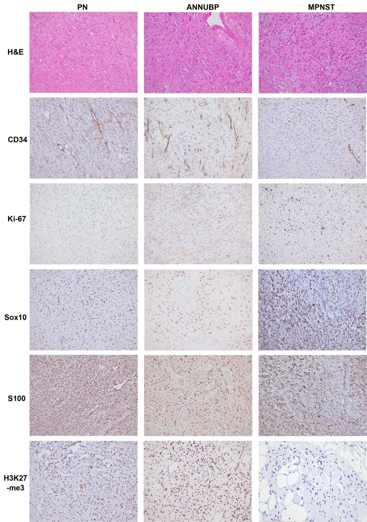 From benign neurofibromas to malignant peripheral nerve sheath tumors (MPNST): a gaming among multiple factors.