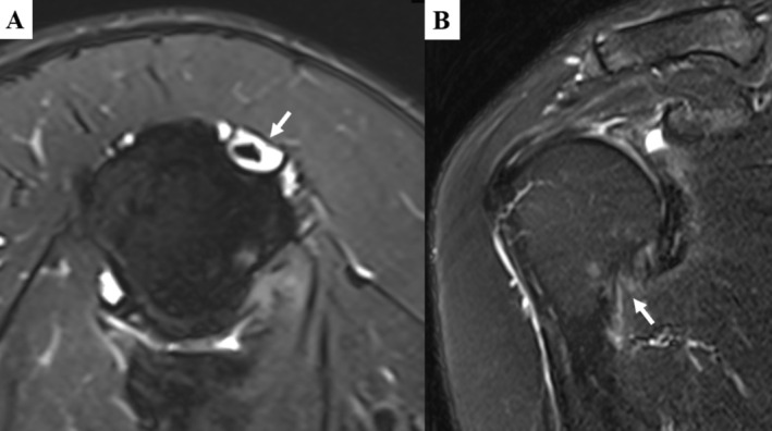 The Long Head of Biceps Tendon Tenotomy in Idiopathic Glenohumeral Adhesive Capsulitis Surgery Improves Early Rehabilitation Outcomes.