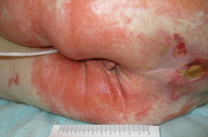 Incontinence-Associated Dermatitis in Older Adults: A Critical Review of Risk Factors, Prevention and Management.