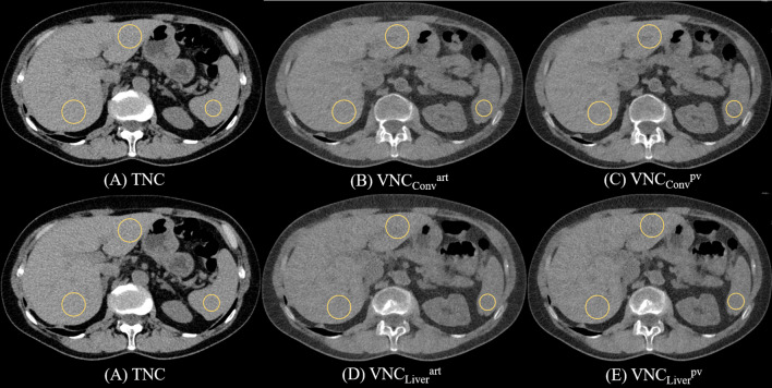 Photon counting detector CT-derived virtual non-contrast images of the liver: comparison of conventional and liver-specific algorithms across arterial and portal venous phase scans.
