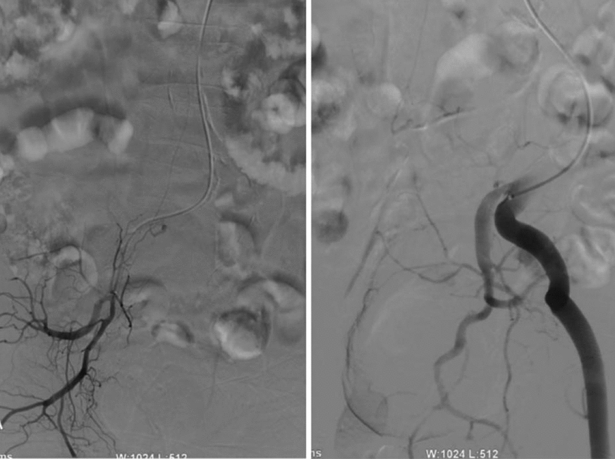 Acute onset of spinal dural arteriovenous fistula and rapid progression to complete paraplegia: a case report and review of the literature.