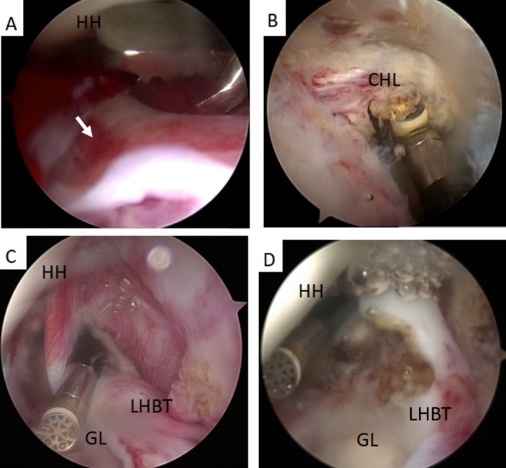 The Long Head of Biceps Tendon Tenotomy in Idiopathic Glenohumeral Adhesive Capsulitis Surgery Improves Early Rehabilitation Outcomes.