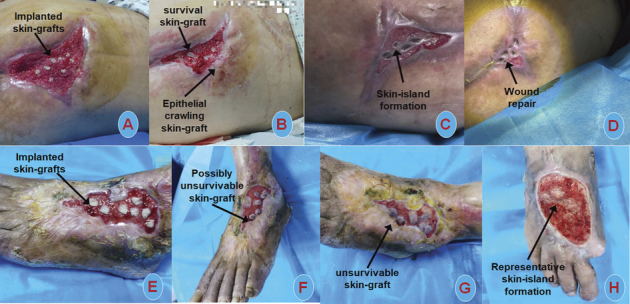 Efficacy of Stamp Skin Grafting to Promote the Healing Process of Chronic Wounds.