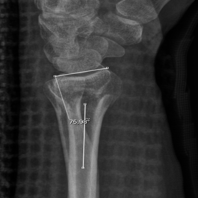 Distal radius fracture - Supination underestimates dorsal tilt in distal radius fracture radiographs: a case report.