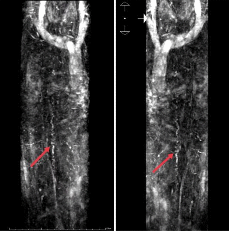 Acute onset of spinal dural arteriovenous fistula and rapid progression to complete paraplegia: a case report and review of the literature.