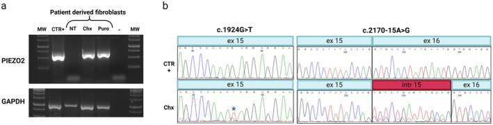 Functional Characterization of a Novel Intronic Variant in PIEZO2 in a Recessive Form of Distal Arthrogryposis With Impaired Proprioception and Touch (DAIPT).