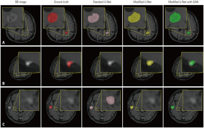 Enhancing Brain Metastases Detection and Segmentation in Black-Blood MRI Using Deep Learning and Segment Anything Model (SAM).