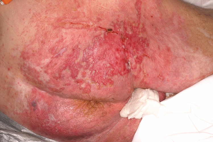 Incontinence-Associated Dermatitis in Older Adults: A Critical Review of Risk Factors, Prevention and Management.