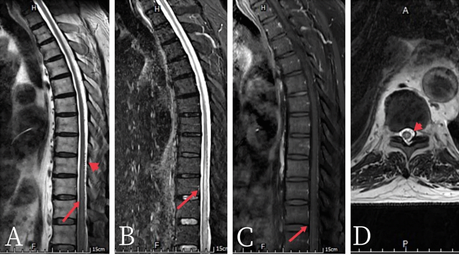 Acute onset of spinal dural arteriovenous fistula and rapid progression to complete paraplegia: a case report and review of the literature.