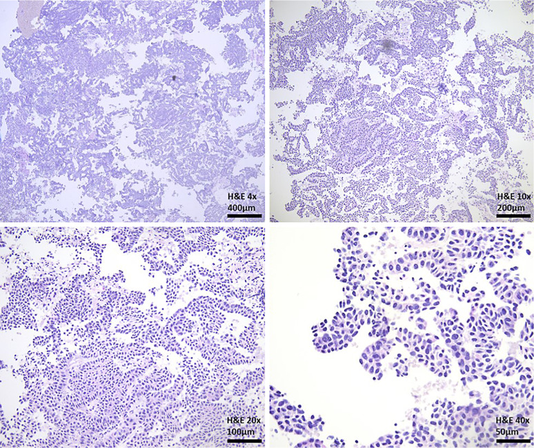A Case Report of Mixed Acinar-Neuroendocrine Pancreatic Carcinoma: A Rare Subtype of Pancreatic Cancer.