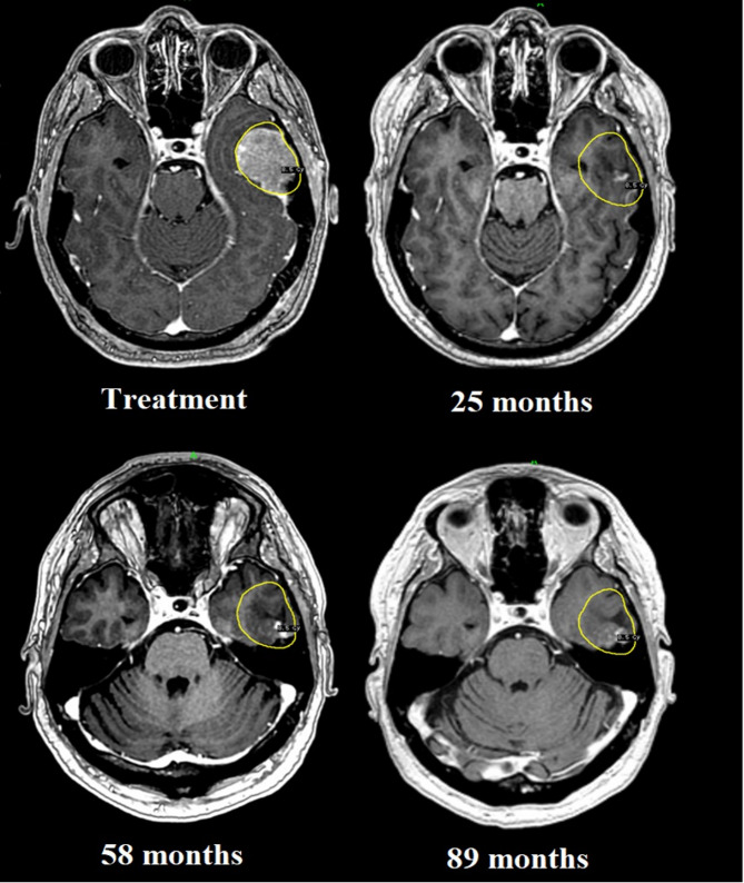 Management of critically located brain metastases in patients with precluded survival using customised double-dose prescription-based, adaptive accelerated staged radiosurgery: a long-term retrospective analysis.