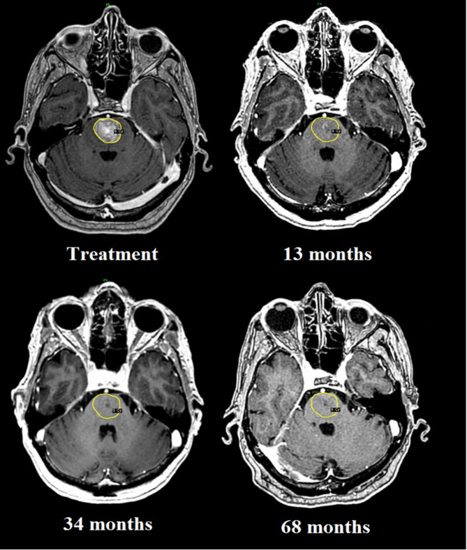 Management of critically located brain metastases in patients with precluded survival using customised double-dose prescription-based, adaptive accelerated staged radiosurgery: a long-term retrospective analysis.