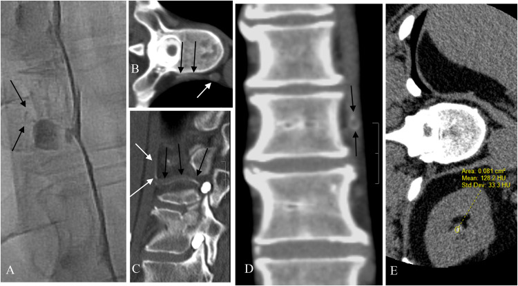 Spontaneous intracranial hypotension due to CSF-venous fistula: Evaluation of renal accumulation of contrast following decubitus myelography and maintained decubitus CT to improve fistula localization.