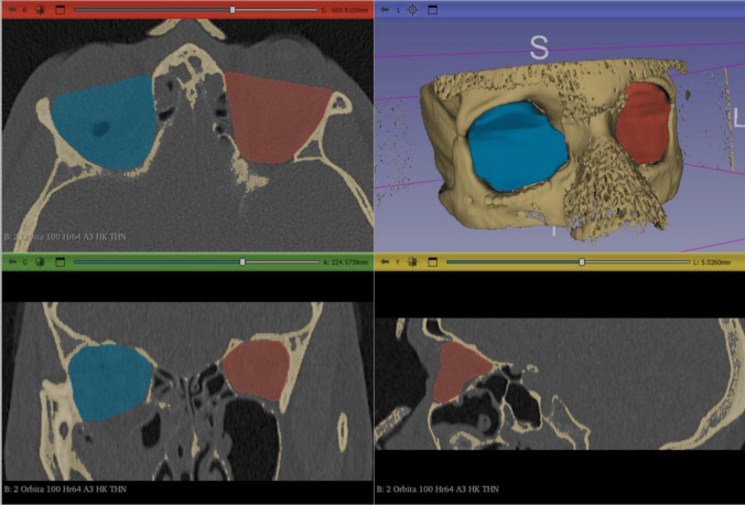 Evaluation of Ultra-High Molecular Weight Polyethylene (UHMWPE) Implants in Orbital Fracture Reconstruction: A Multicenter Cohort Study.