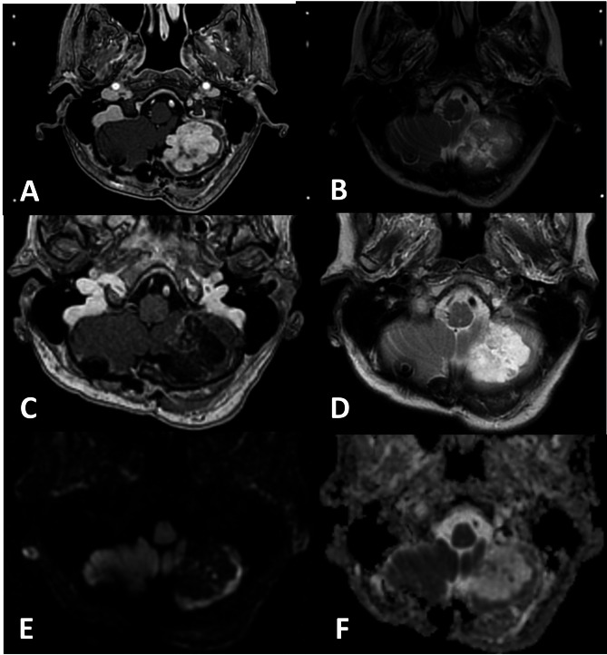 Management of critically located brain metastases in patients with precluded survival using customised double-dose prescription-based, adaptive accelerated staged radiosurgery: a long-term retrospective analysis.