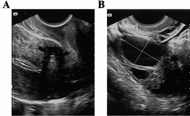 Live birth following multimodal therapy in a patient with asherman's syndrome, recurrent pregnancy loss, and polycystic ovarian syndrome: a case report and literature review.