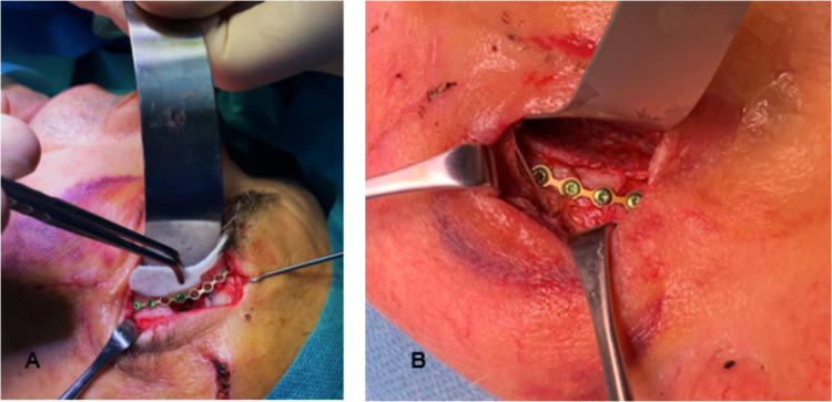 Evaluation of Ultra-High Molecular Weight Polyethylene (UHMWPE) Implants in Orbital Fracture Reconstruction: A Multicenter Cohort Study.