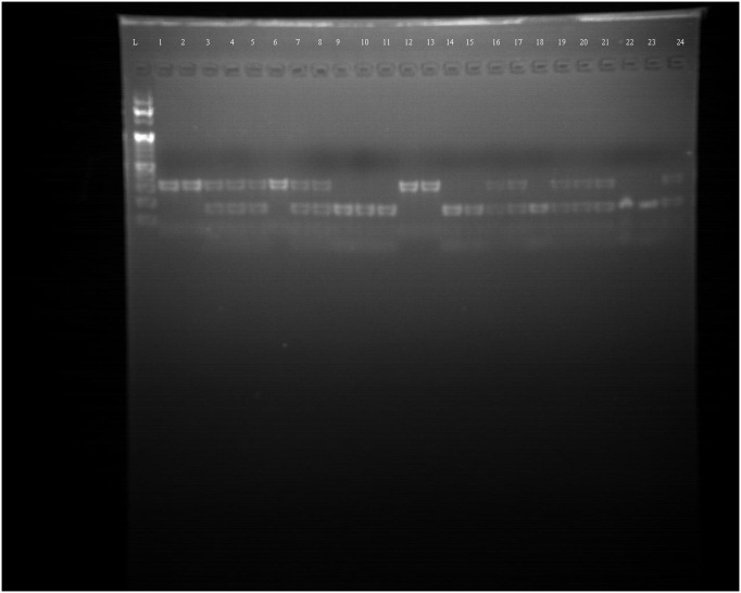Association of FGF Receptor-2rs2981578 SNP with breast cancer in women at the University of Gondar Comprehensive Specialized Hospital, Ethiopia.