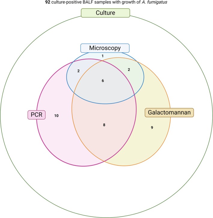Diagnostic Value of Microscopy, Galactomannan, and PCR in Aspergillus Culture-Positive BALF Samples: A Laboratory-Based Pilot Study.