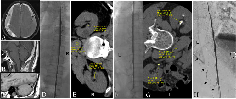 Spontaneous intracranial hypotension due to CSF-venous fistula: Evaluation of renal accumulation of contrast following decubitus myelography and maintained decubitus CT to improve fistula localization.