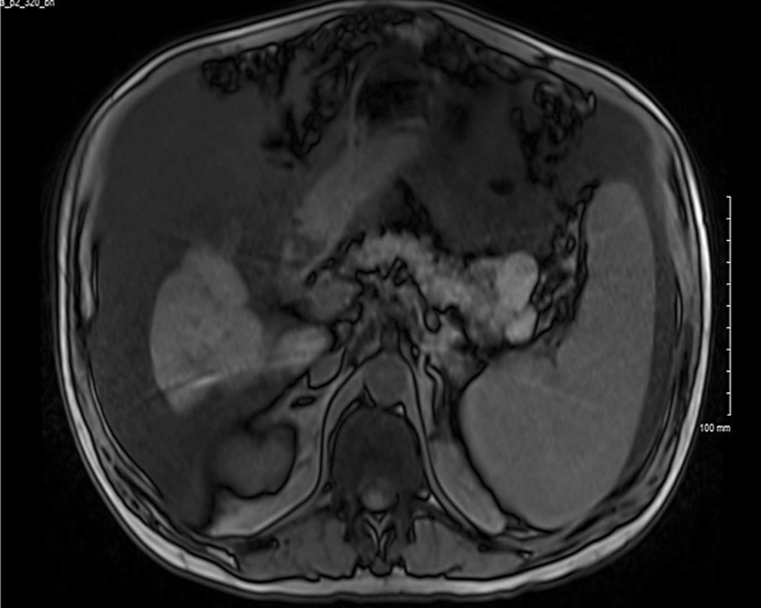 A Case Report of Mixed Acinar-Neuroendocrine Pancreatic Carcinoma: A Rare Subtype of Pancreatic Cancer.