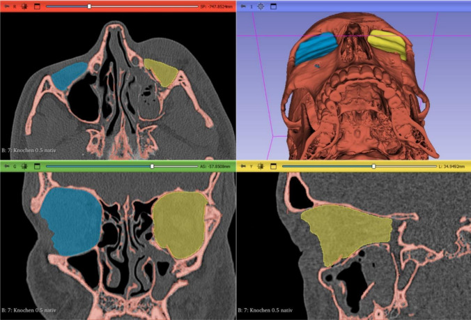 Evaluation of Ultra-High Molecular Weight Polyethylene (UHMWPE) Implants in Orbital Fracture Reconstruction: A Multicenter Cohort Study.