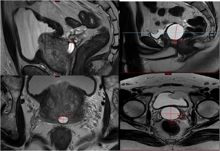 Prevalence and Characteristics of Prostatic Utricles: A Retrospective MRI Study in Middle-Aged to Elderly Men.