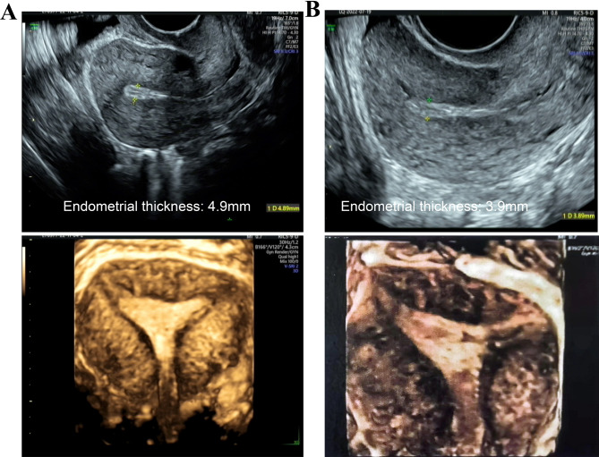 Live birth following multimodal therapy in a patient with asherman's syndrome, recurrent pregnancy loss, and polycystic ovarian syndrome: a case report and literature review.