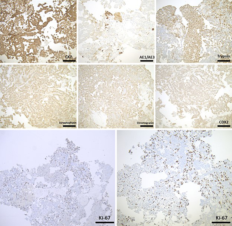 A Case Report of Mixed Acinar-Neuroendocrine Pancreatic Carcinoma: A Rare Subtype of Pancreatic Cancer.
