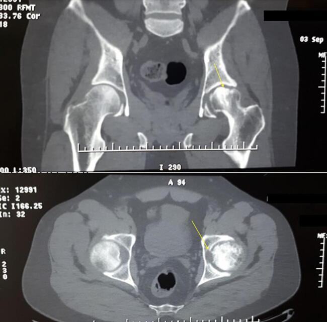 Unexpected transient femoral nerve palsy following epidural catheterization in total hip arthroplasty: A rare case report.