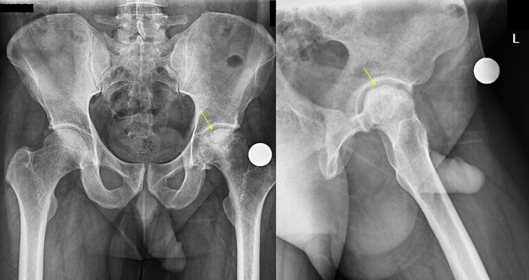 Unexpected transient femoral nerve palsy following epidural catheterization in total hip arthroplasty: A rare case report.